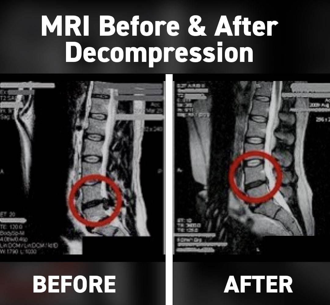 dc-spinal-decompression-before-after1