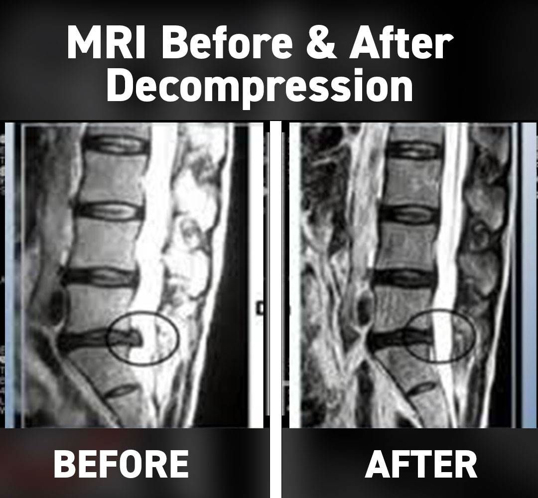 MRI scan comparison showing spine before and after non surgical spinal decompression therapy in Dublin