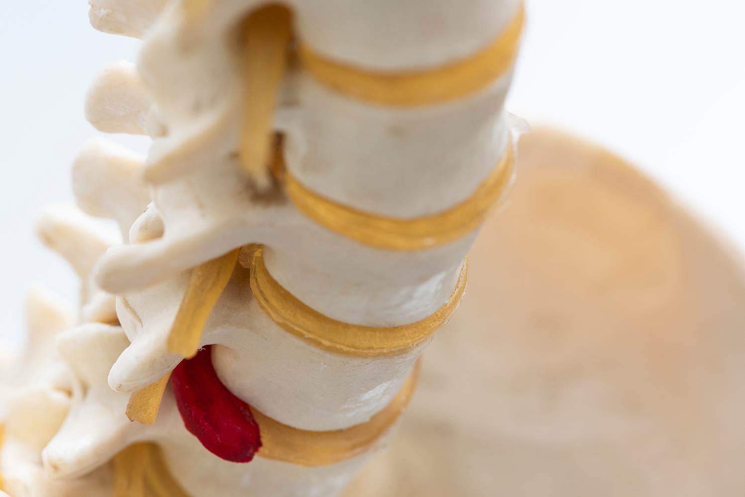 Close-up view of artificial human herniated lumbar intervertebral disc model