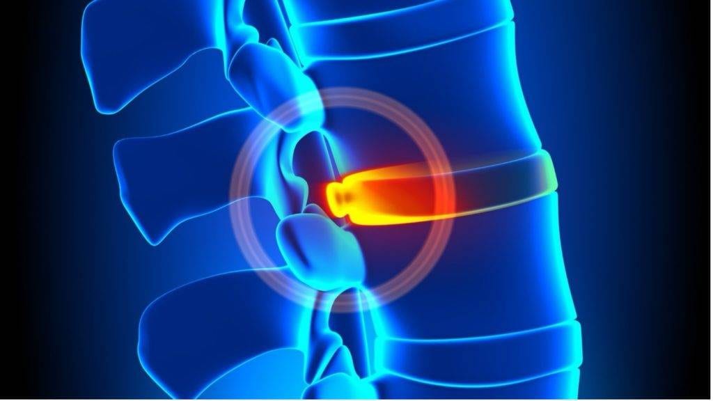 Treat Bulging Discs with Non-Surgical Spinal Decompression