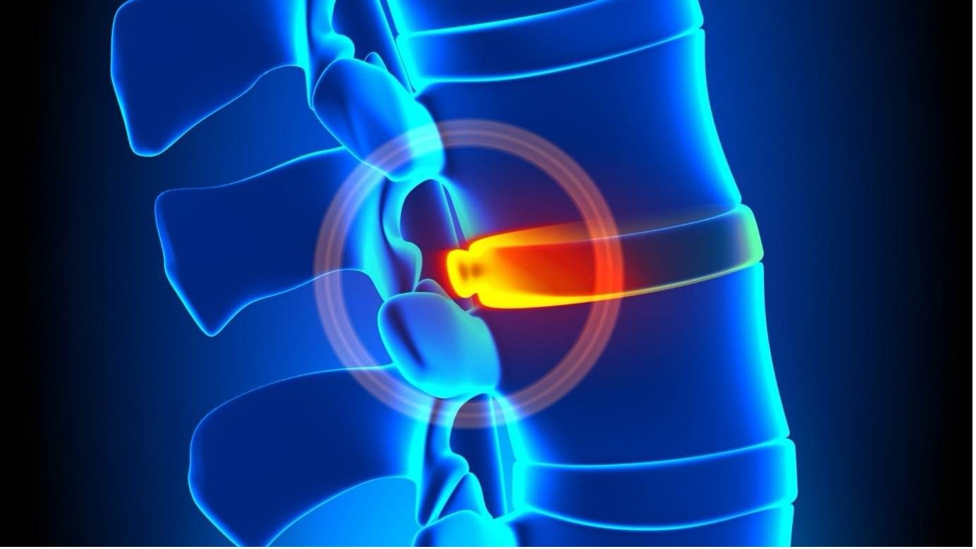 Treat Bulging Discs with Non-Surgical Spinal Decompression