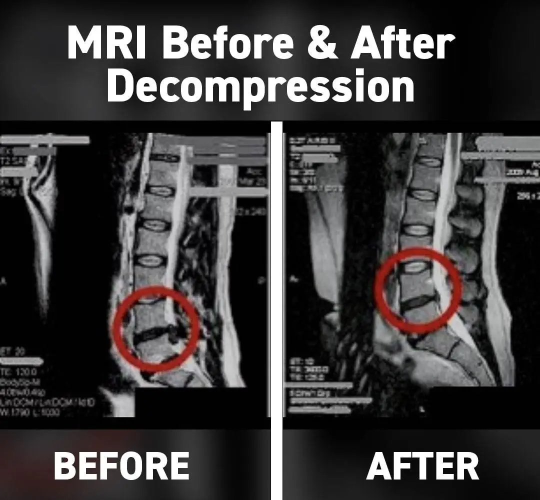 dc-spinal-decompression-before-after1 dc-spinal-decompression-before-after1