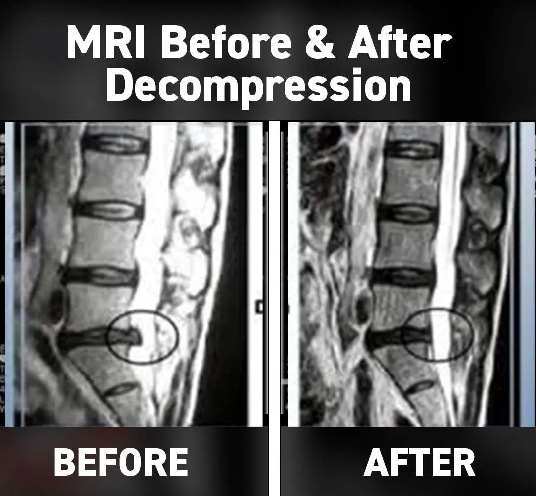 dc-spinal-decompression-before-after2 dc-spinal-decompression-before-after2