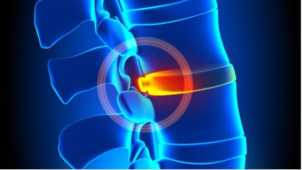 Treat Bulging Discs with Non-Surgical Spinal Decompression